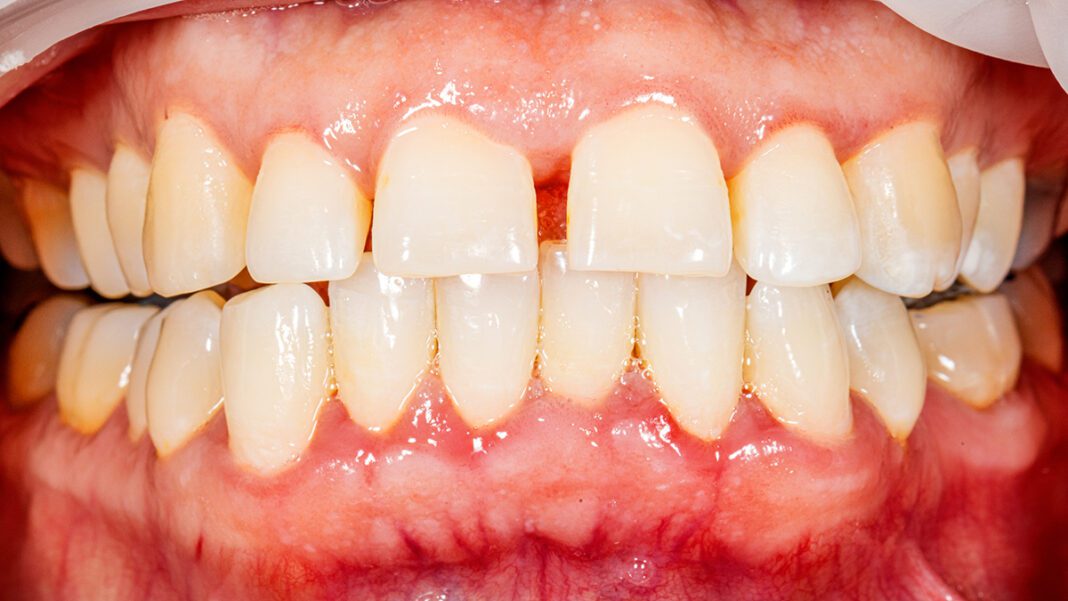Your Teeth Could Reveal How Long You’ll Live, Study Suggests